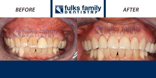 A before and after picture of a person 's teeth from fulks family dentistry