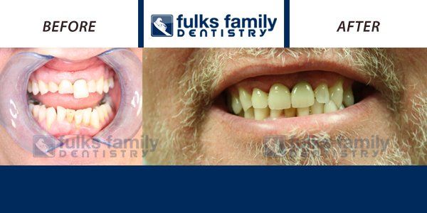 A before and after picture of a man 's teeth from fulks family dentistry
