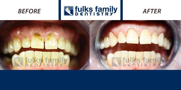 A before and after picture of a person 's teeth from fulks family dentistry