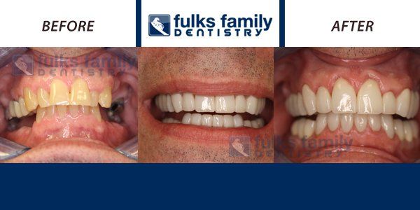 A before and after picture of a man 's teeth from fulks family dentistry