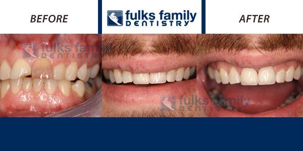 A before and after picture of a man 's teeth from fulks family dentistry