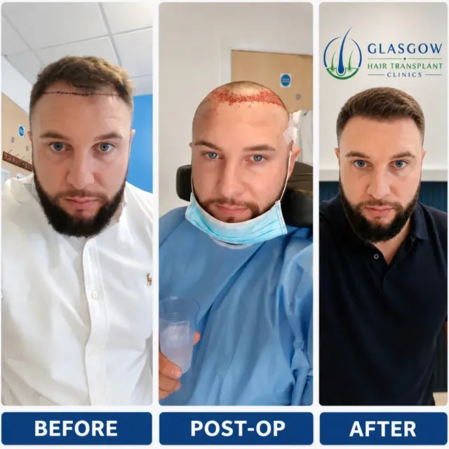 Hair transplant before and after result Birmingham