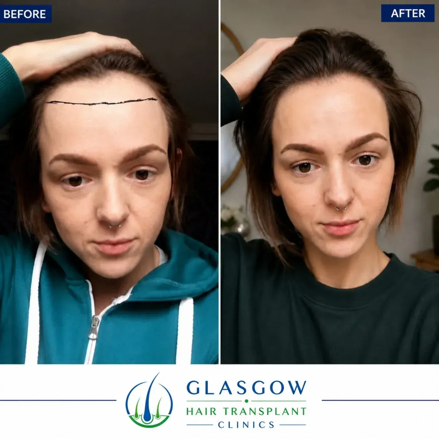 Female hairline restoration result
