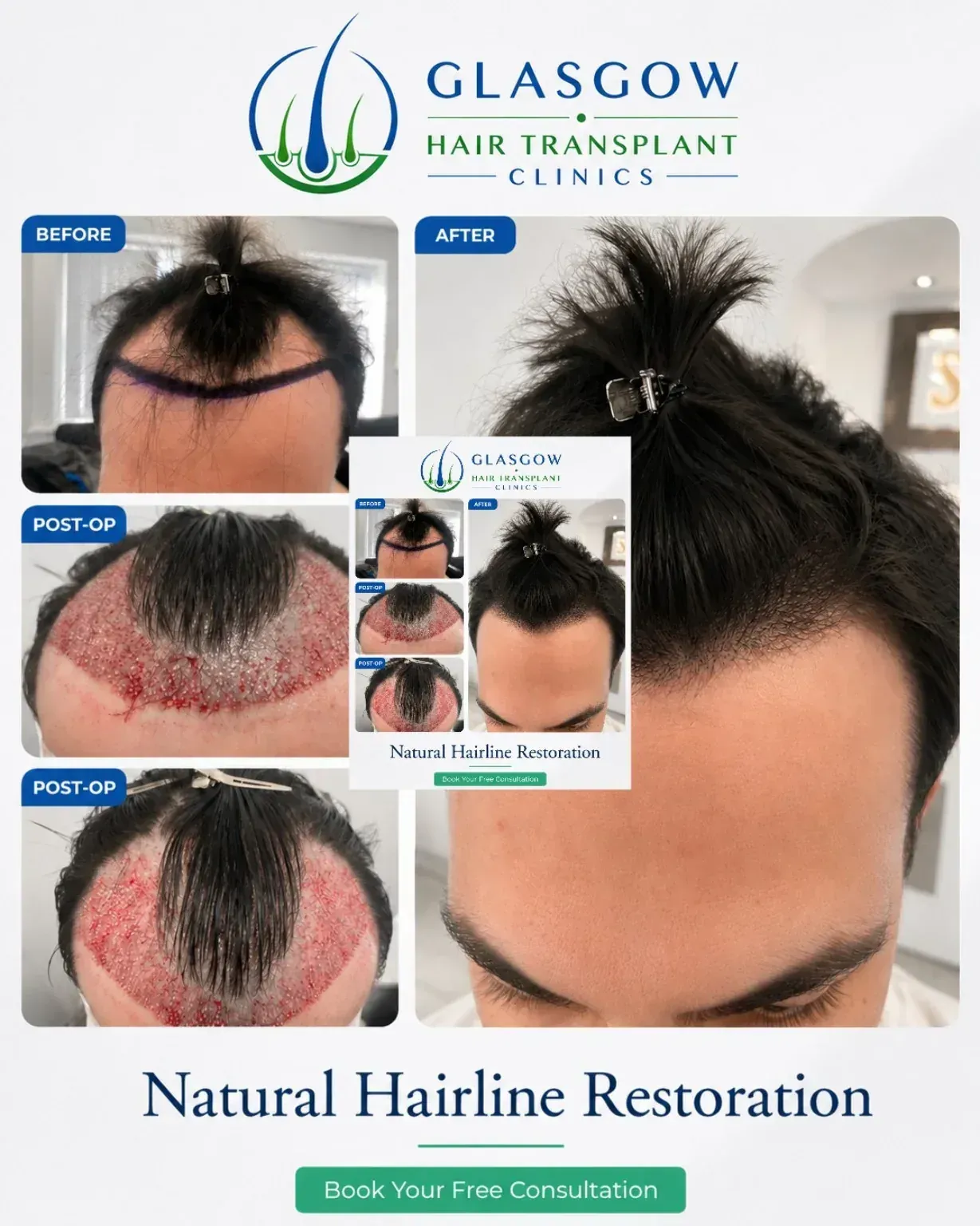 Hairline transplant before and after result
