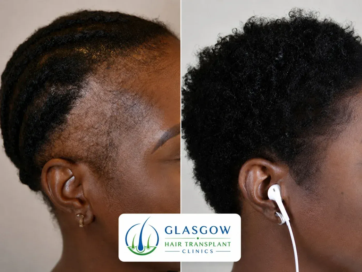 Hair-restoration before and after result