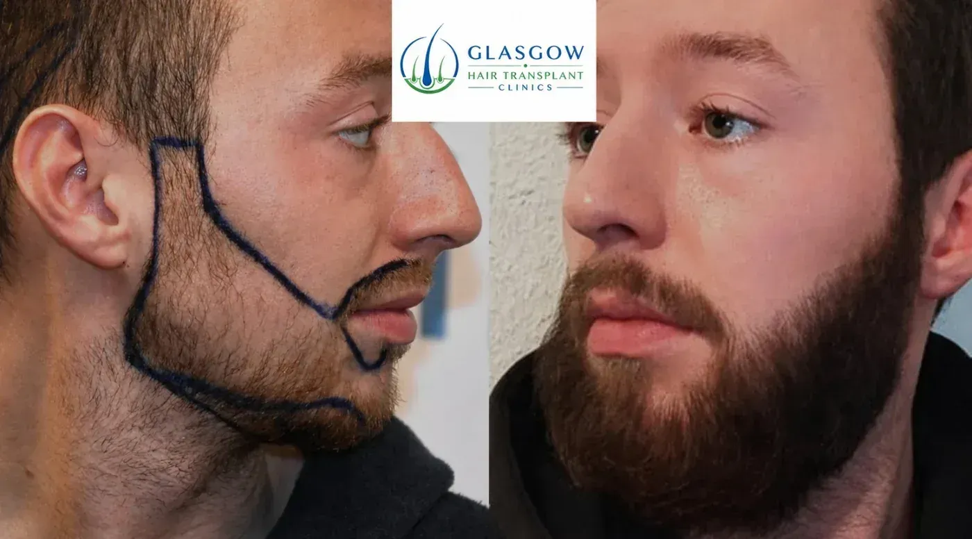Beard transplant before and after side profile