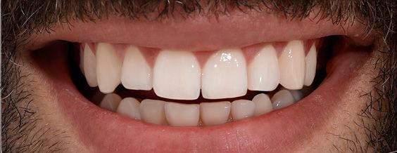 Close-up of bright white teeth in a smiling mouth with healthy pink gums.