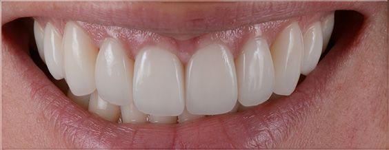 A close-up of a person's smiling mouth, showing white, evenly spaced teeth and pink lips.