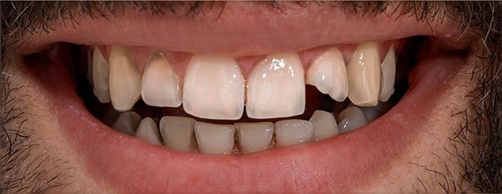 Close-up of teeth, showing white teeth with a gap between the two front teeth. The person is smiling.