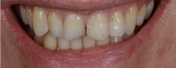 Close-up of a smiling person's mouth; slightly yellow teeth with a gap between the two front teeth.
