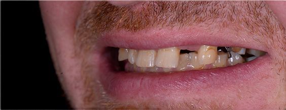 Close-up of a person's teeth, showing a slightly crooked smile, with visible white teeth and pink gums.