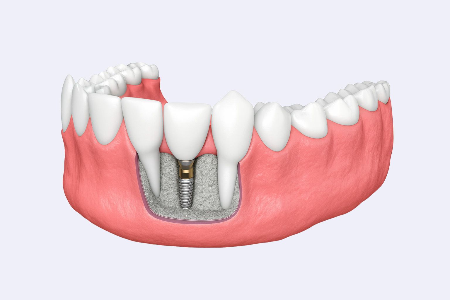 Dental implant in a jaw; shows screw implant in bone, crown, and adjacent teeth.