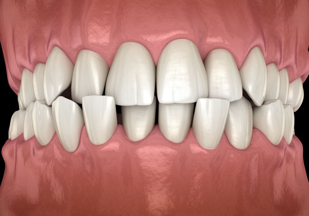 Close-up of human teeth showing irregular shape, with a focus on the front teeth.