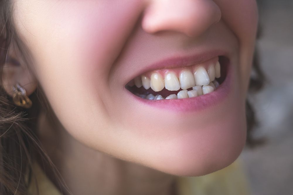Smiling person; close-up on mouth, showing imperfect teeth and pink gums.