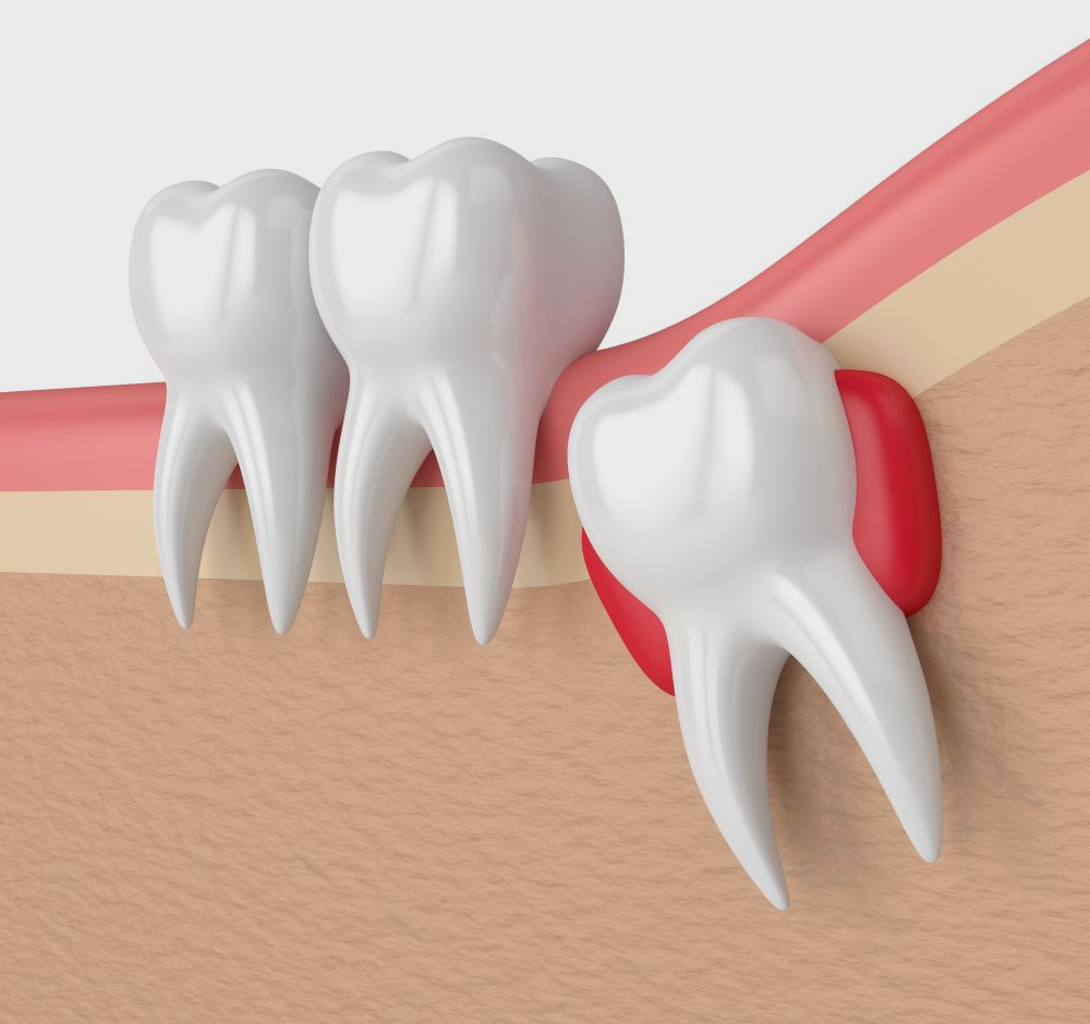Illustration of impacted wisdom tooth pushing against other teeth in gum tissue.