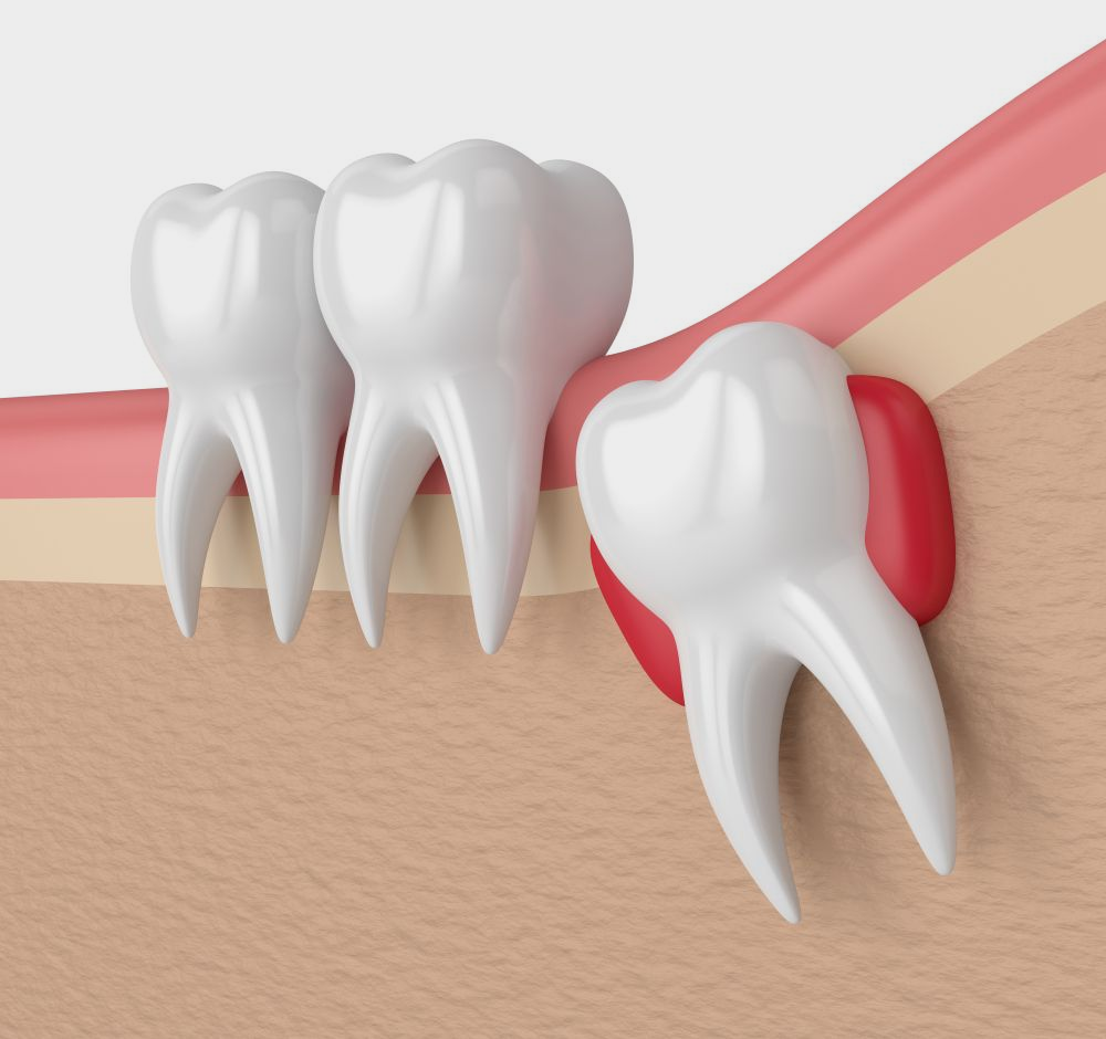Dental illustration of impacted wisdom tooth causing red inflammation; other teeth healthy.