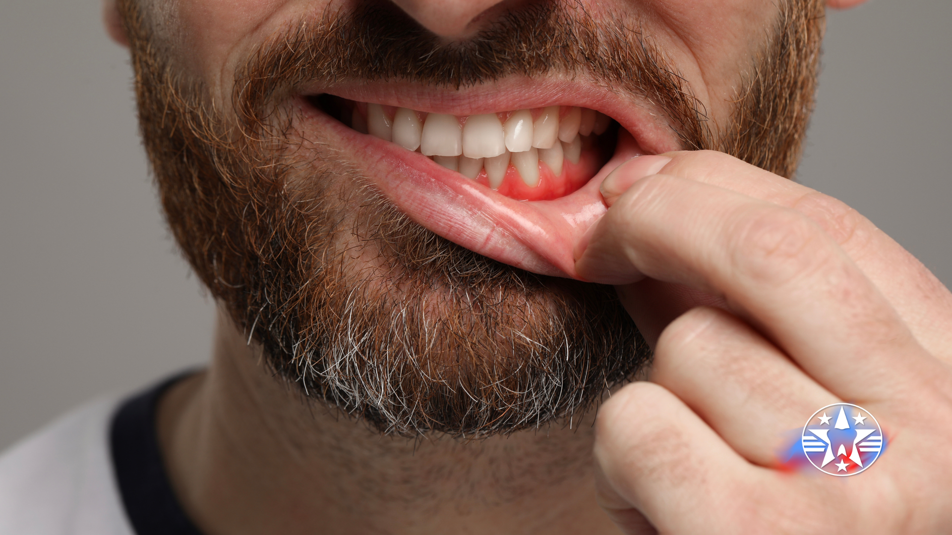 Man with beard pulling down his lower lip, exposing inflamed gums.