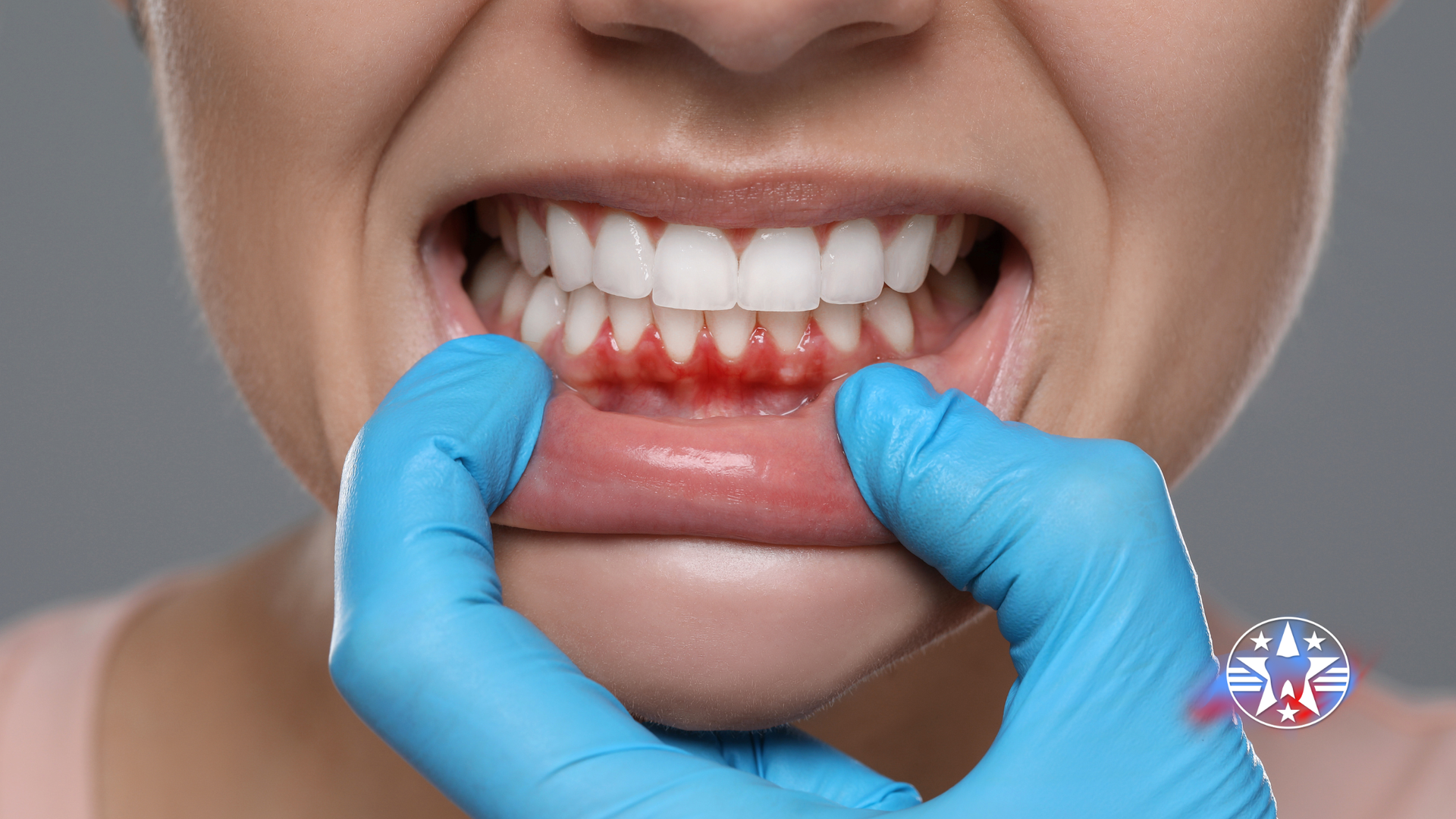 Person's mouth showing inflamed gums. Blue-gloved hand pulls lip down. Red and white teeth visible.
