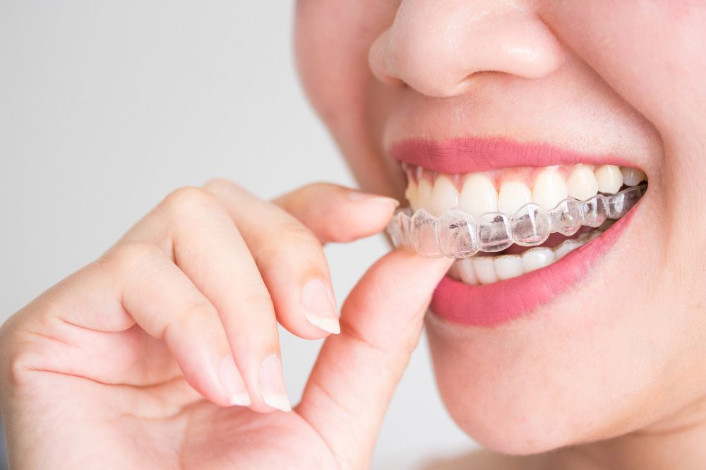Woman inserting clear aligner to teeth.