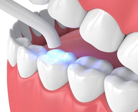 Dental filling procedure: Dentist using a curing light on a filled tooth, other teeth visible.