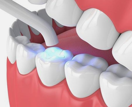 Dental filling being cured with blue light.