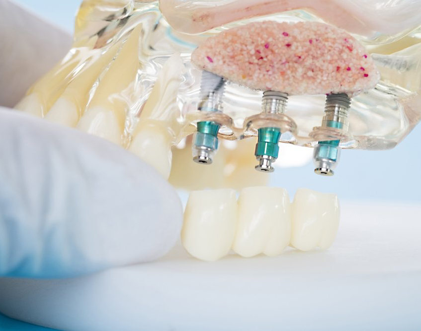 implantes com regeneração óssea