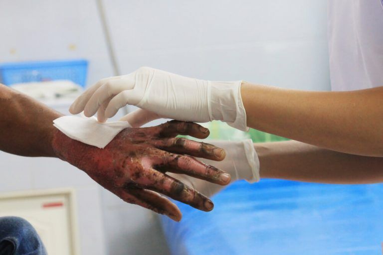 Fire injury