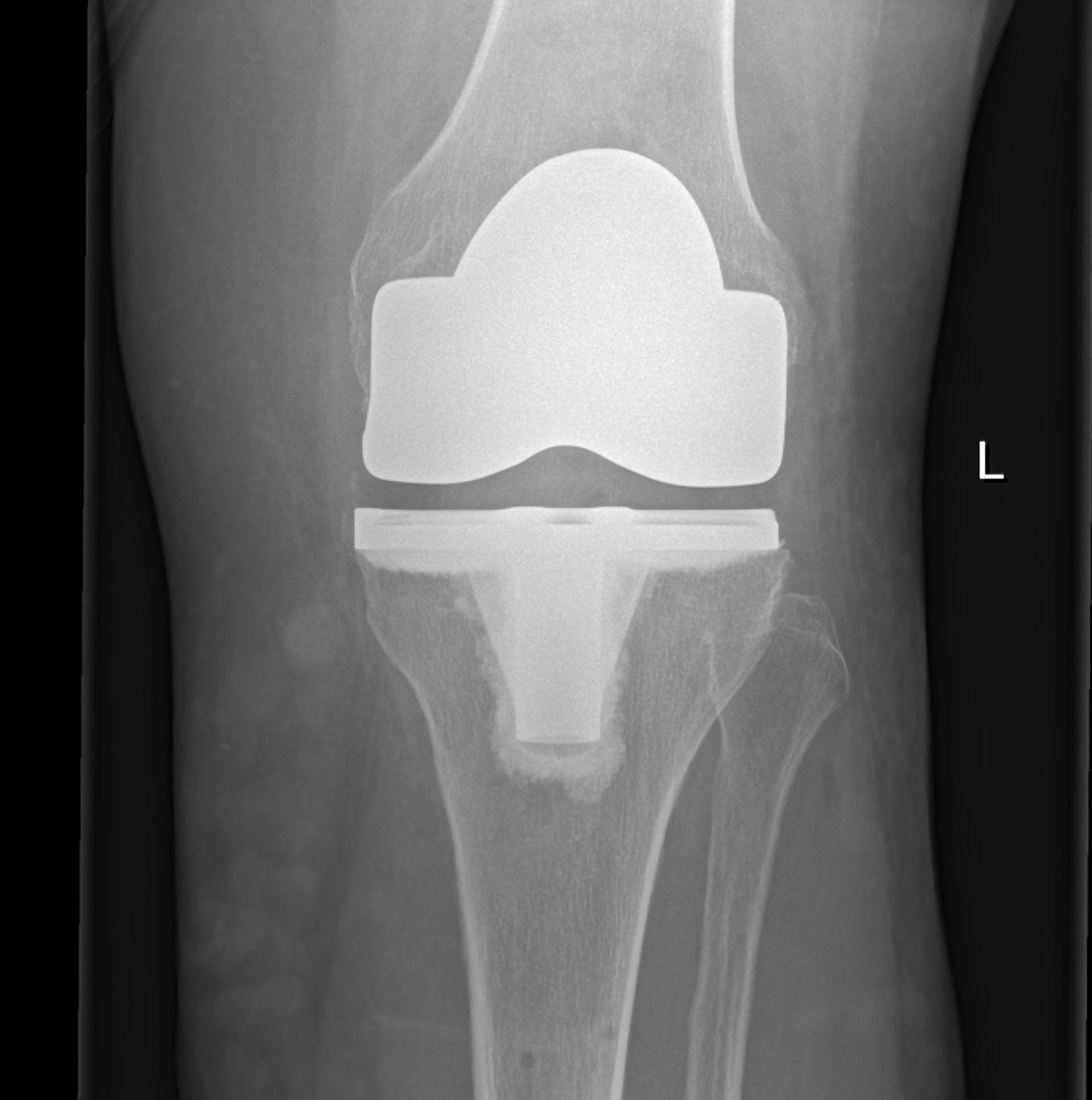 total-knee-replacement-knee-dr-neil-ferguson-armidale