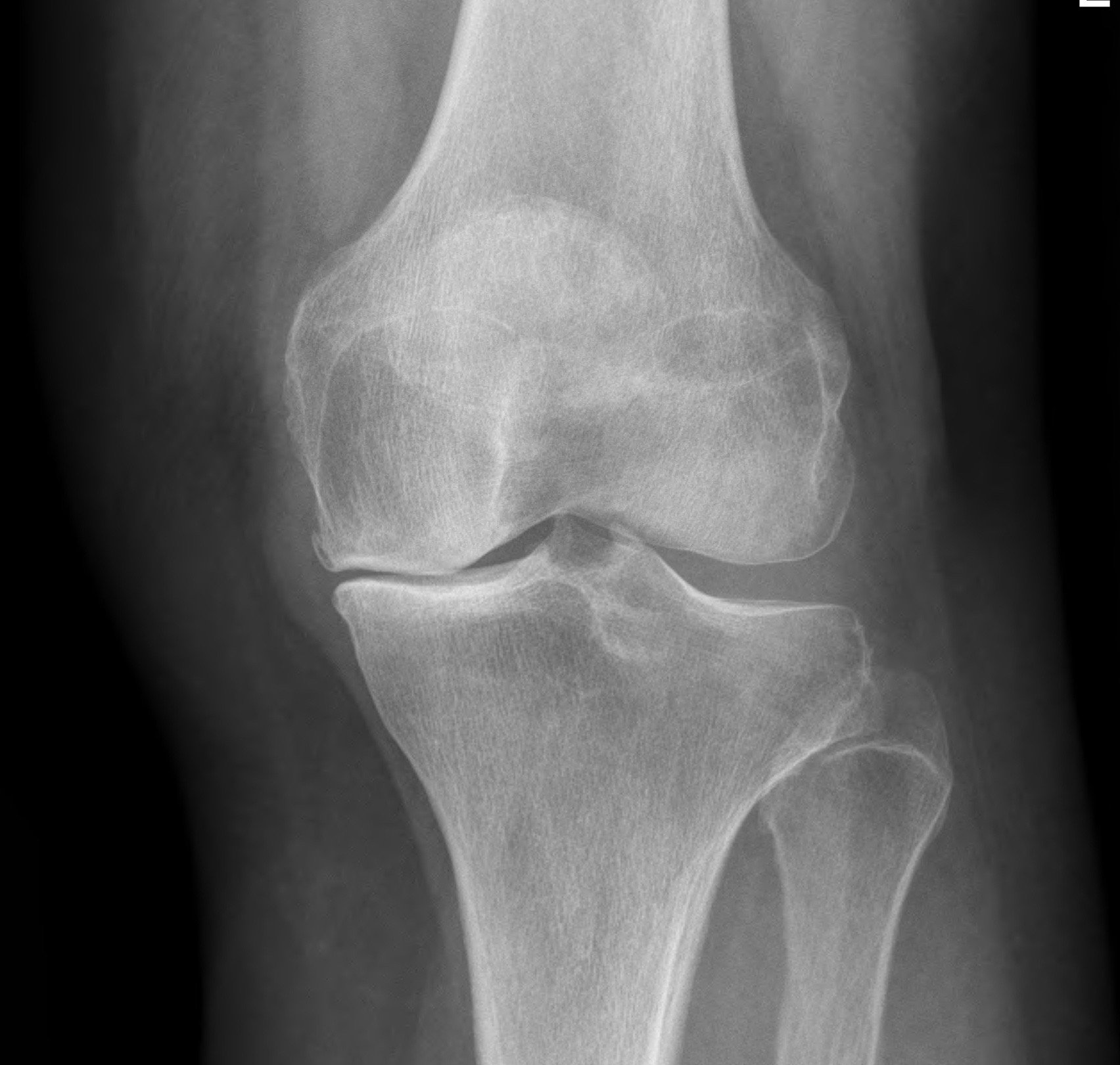 total-knee-replacement-knee-dr-neil-ferguson-armidale