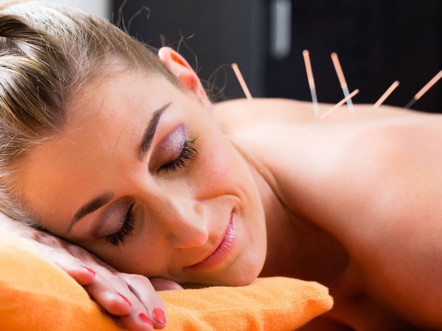 Give Acupuncture a Try in Bismarck, ND