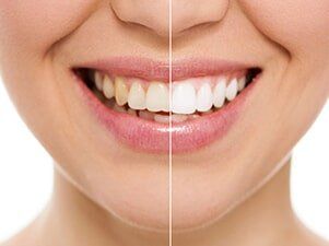 Before and After Whitening - Dentist in Mansfield, OH