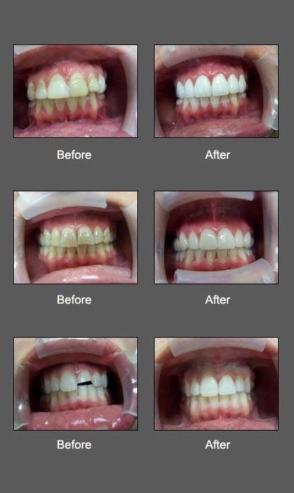 A before and after picture of a person 's teeth