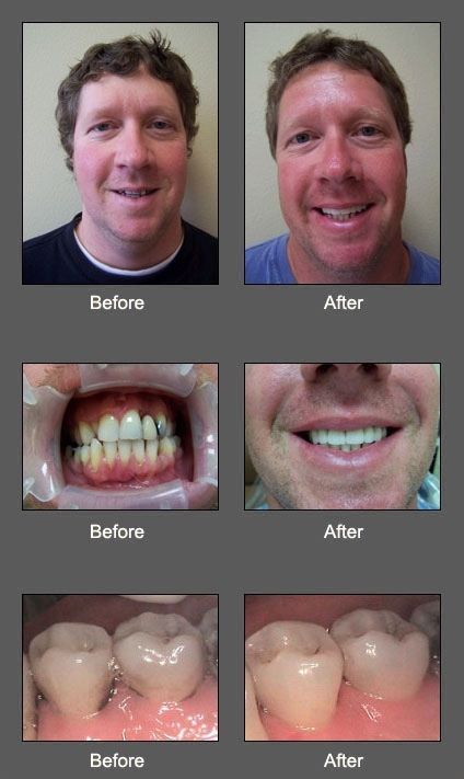 A before and after picture of a man 's teeth