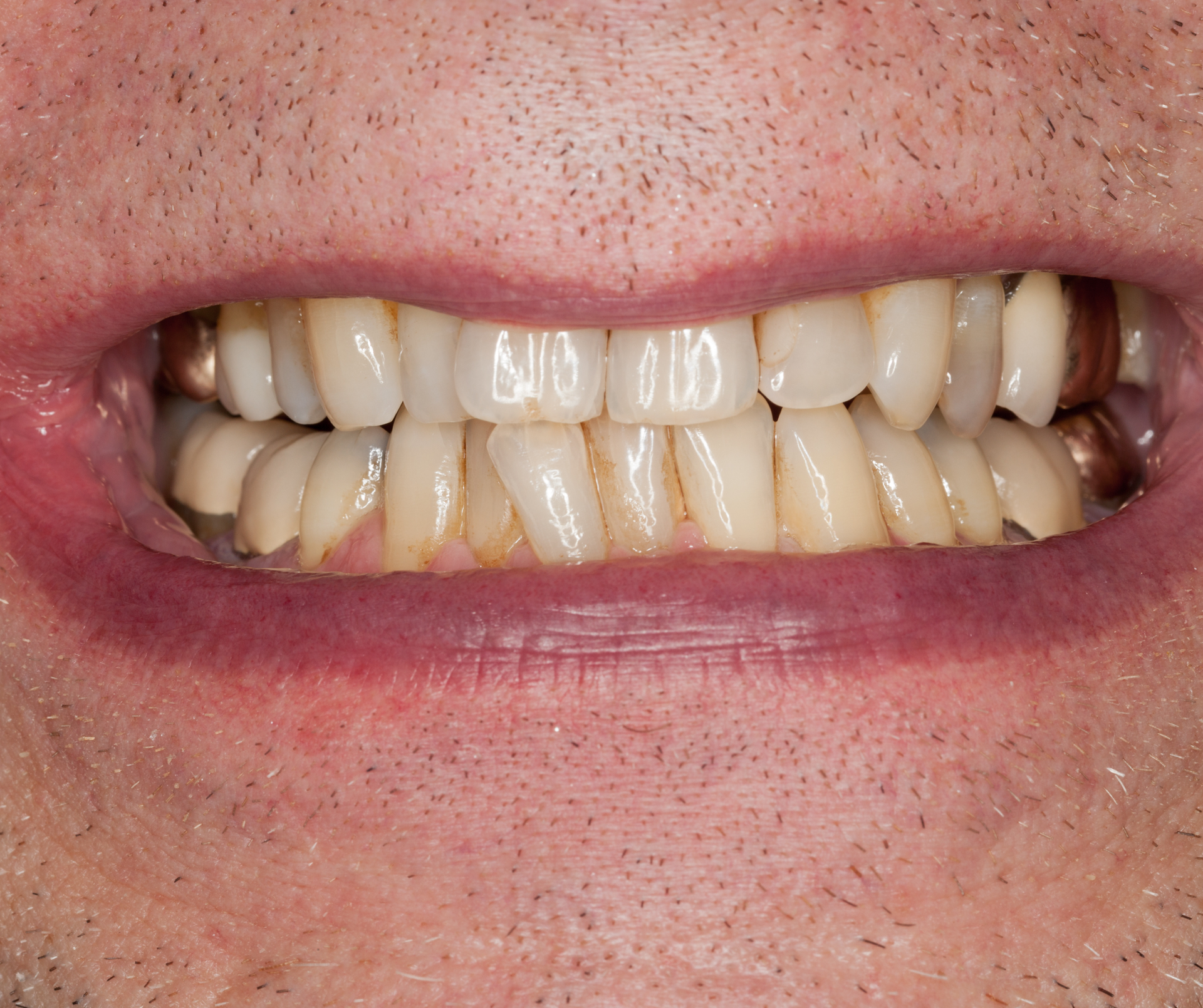 Close-up of a person's teeth, showing yellowing and some gold crowns.