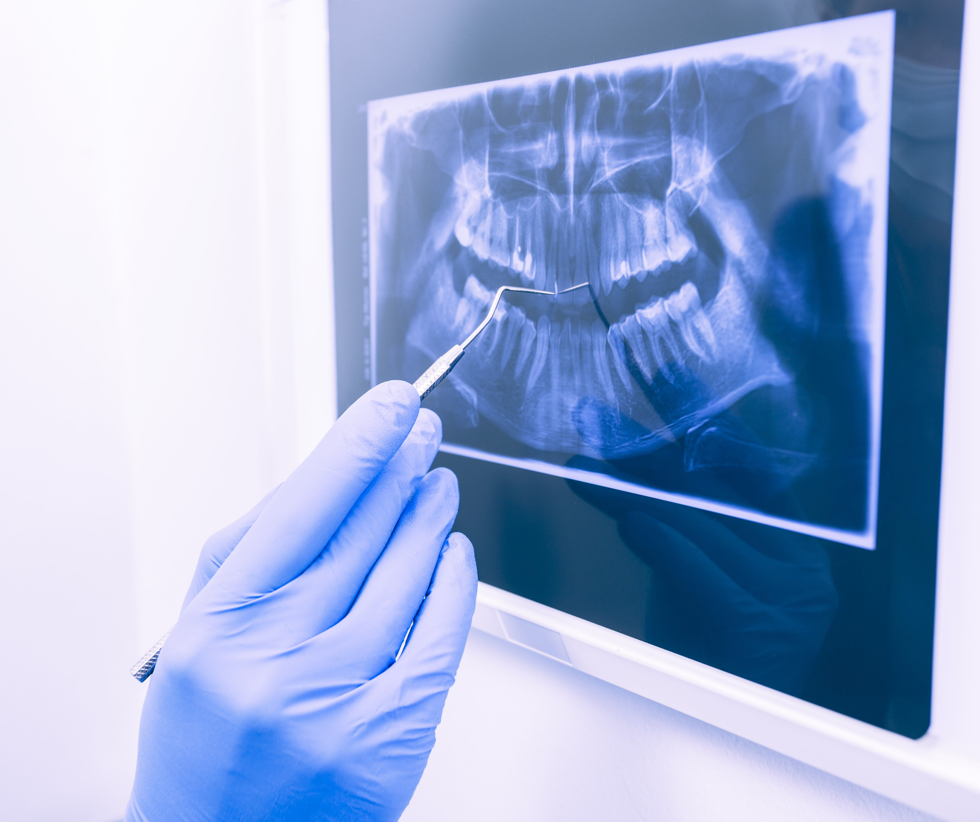 Gloved hand pointing at dental X-ray, teeth visible. Blue tone.