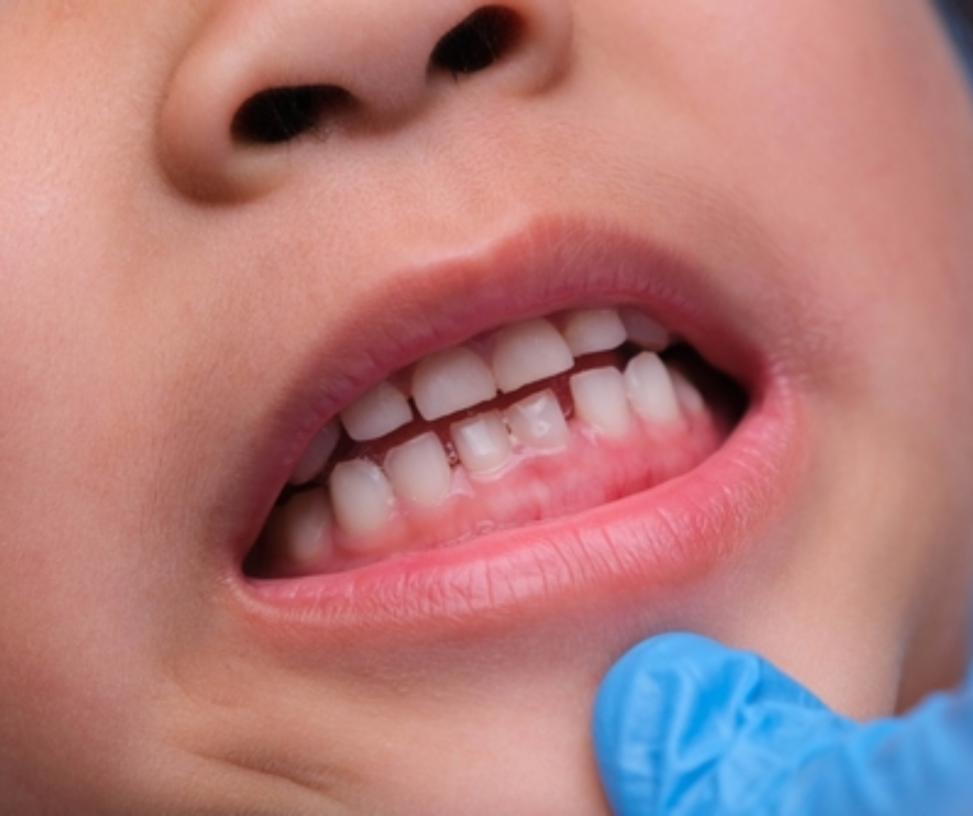 Child's mouth, chipped front tooth, pink gums, blue-gloved hand examining.