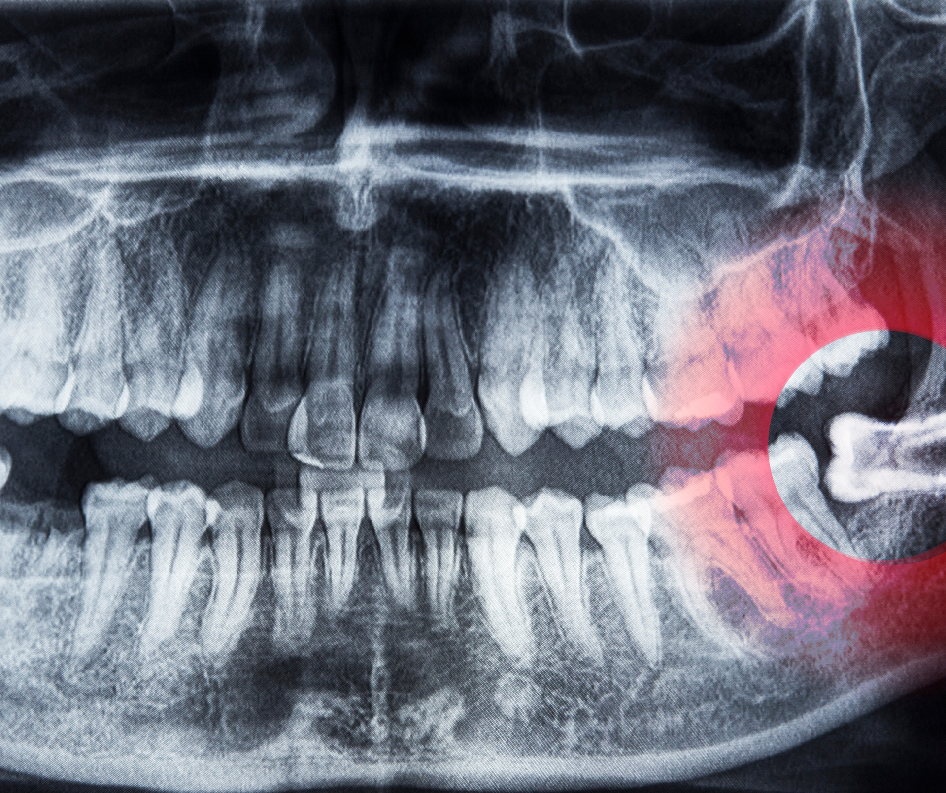 Dental X-ray showing teeth and jaw, with a highlighted area indicating potential issue near a wisdom tooth.