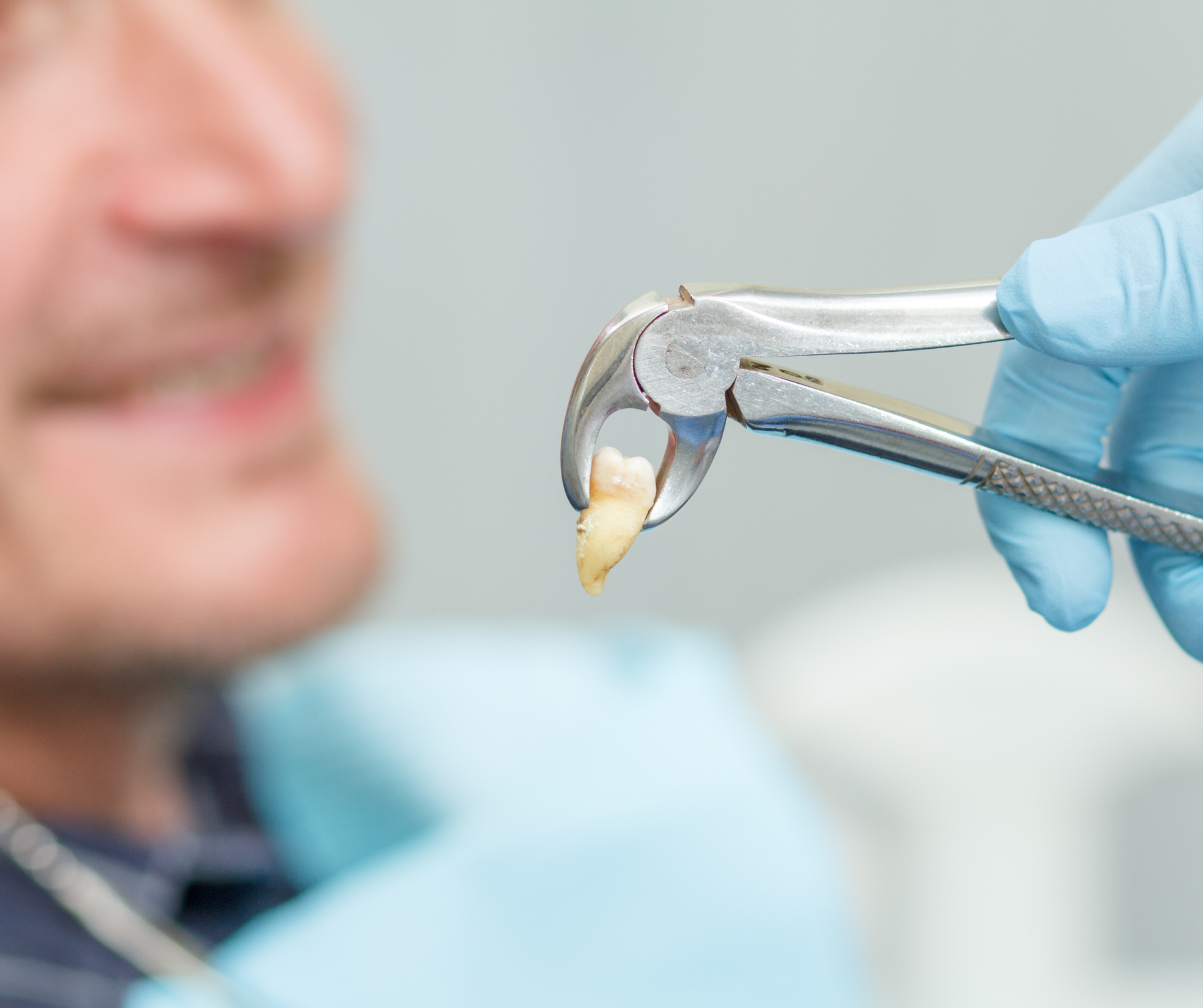 Tooth extraction with dental pliers. A tooth is held by pliers, patient in the background.