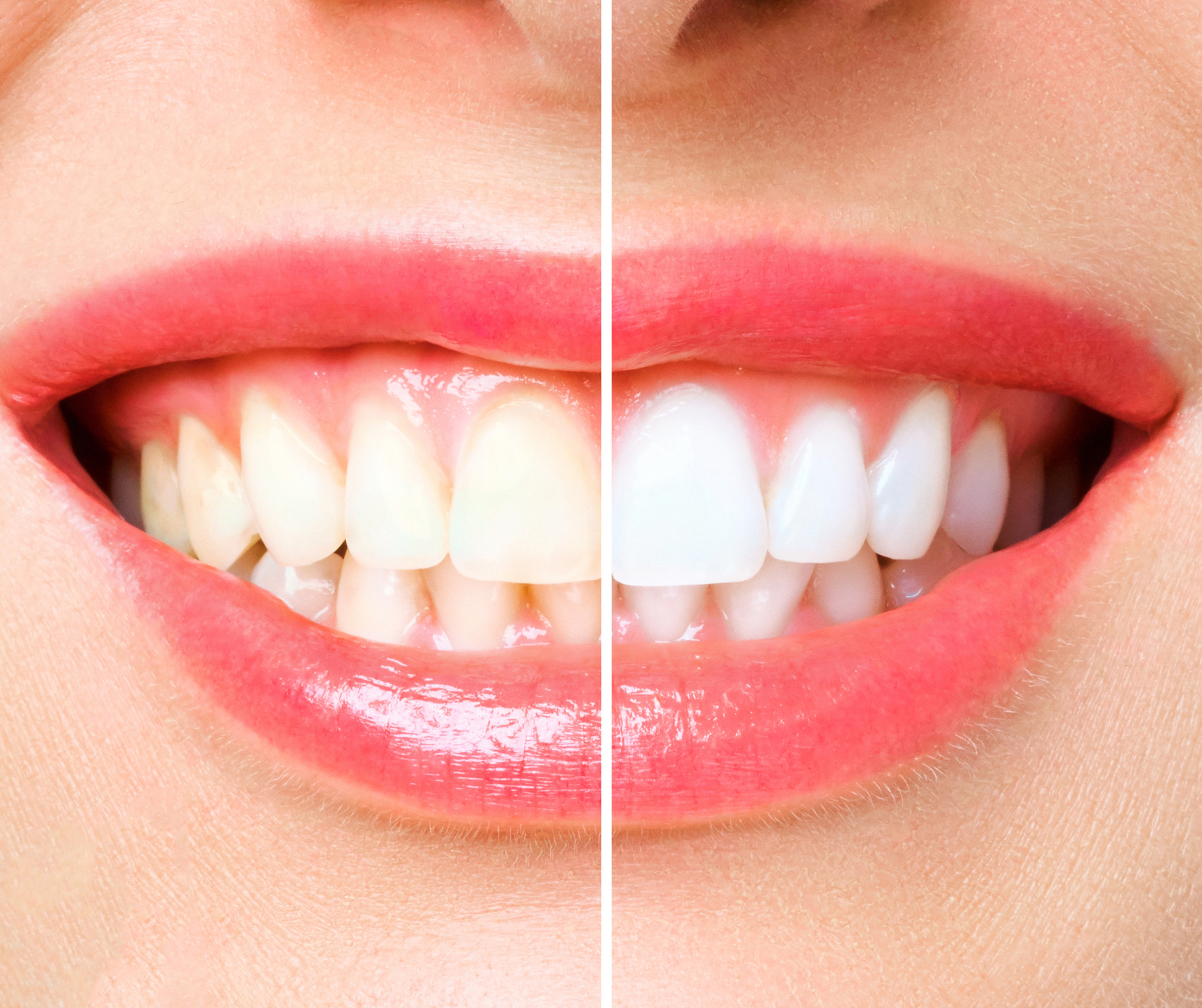 Close-up of a smiling mouth with teeth, showing a before and after teeth whitening comparison.