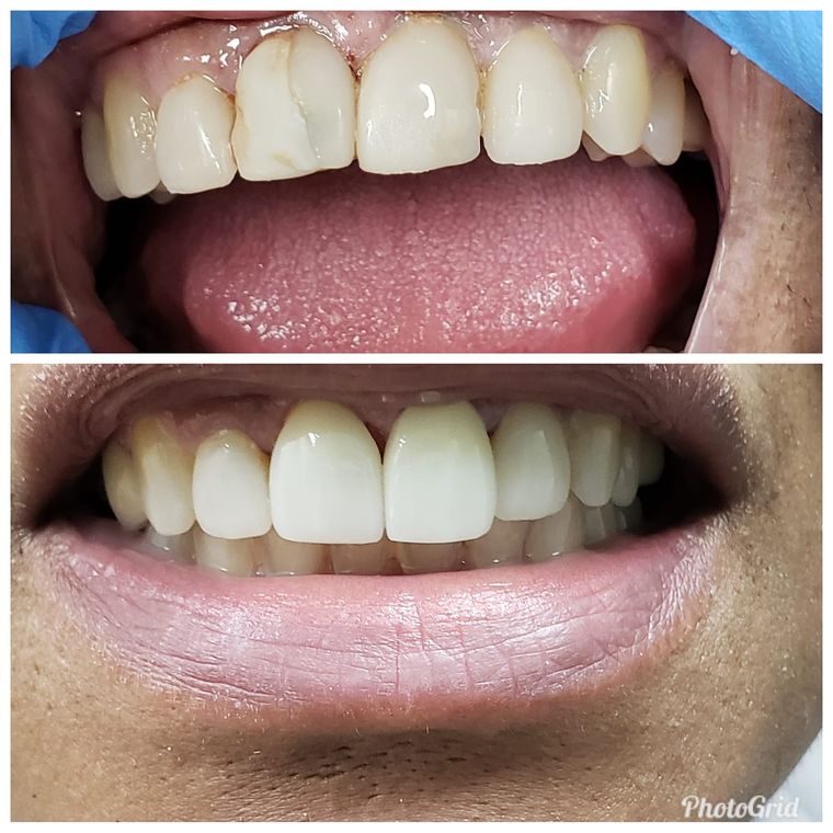 Teeth whitening in Louisville, Kentucky at Sparkle and Shine Dental