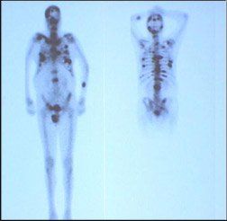 Therapetic Nuclear Med