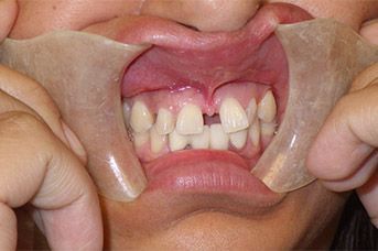 A close up of a person 's mouth with a piece of plastic covering it.