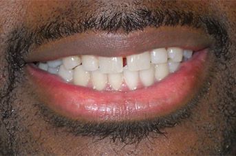 A close up of a man 's mouth with a beard and teeth.