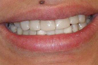 A close up of a woman 's smile with white teeth.