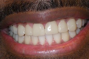 A close up of a man 's teeth with a beard.