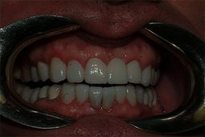 A close up of a person 's teeth with a mouth guard.