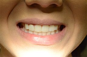 A close up of a woman 's mouth with her teeth showing.