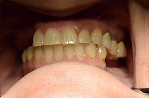 A close up of a person 's teeth and mouth.