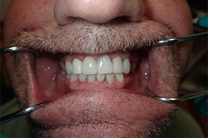 A close up of a man 's mouth with a beard and white teeth.