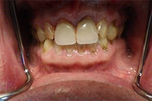 A close up of a person 's teeth with a metal brace.